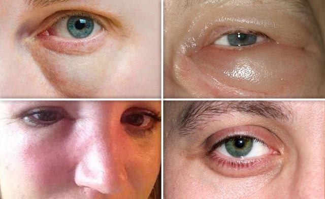 Опухлі очі - причини і як позбутися в домашніх умовах