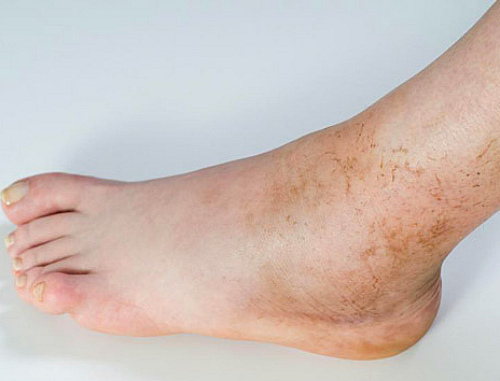 Темні плями або крапки на ногах - причини, фото і як позбутися