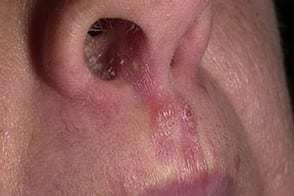 Інфекції носа і шкіри навколо - види, фото, симптоми, лікування