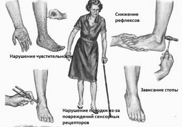 Діабетична полінейропатія кінцівок нижніх і верхніх: лікування, препарати, народні засоби, симптоми, дистальна і сенсорна форми, що це