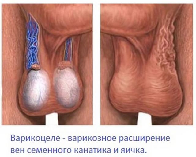 Варикоцеле 1 ступеня у чоловіків і підлітків: лікування (операція, без операції)
