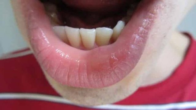 Слизова кіста на губі - симптоми, причини, лікування