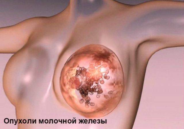 Печіння в грудях - можливі причини і домашні засоби