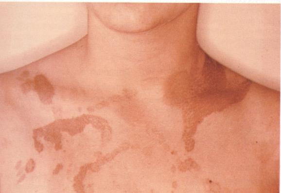 Темні плями на шиї, грудей і тулуб - причини, фото і як позбутися