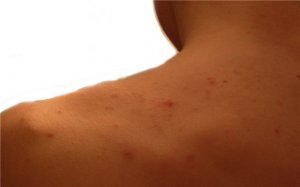 Погана нездорова шкіра - причини, лікування і профілактика