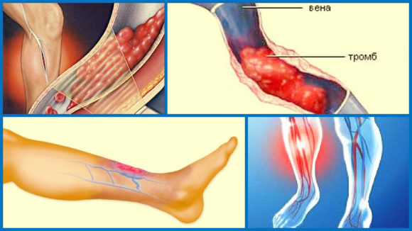 Тромбофлебіт глибоких вен нижніх кінцівок: причини, симптоми (хронічного, гострого), діагностика, лікування, профілактика (харчування), ускладнення