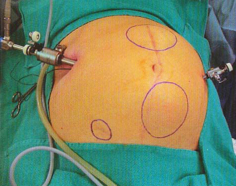 Лапароскопія при варикоцеле: показання, протипоказання, підготовка, як проходить операція, реабілітація (дієта, статеве життя), ускладнення, відгуки