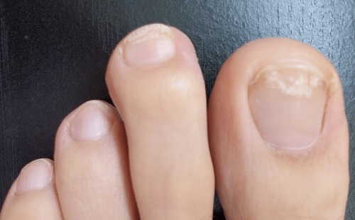 Білі плями на нігтях ніг - причини і лікування