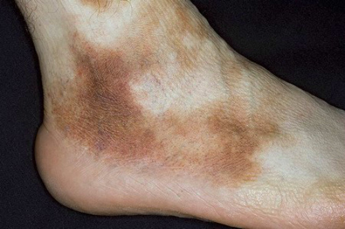 Темні плями або крапки на ногах - причини, фото і як позбутися