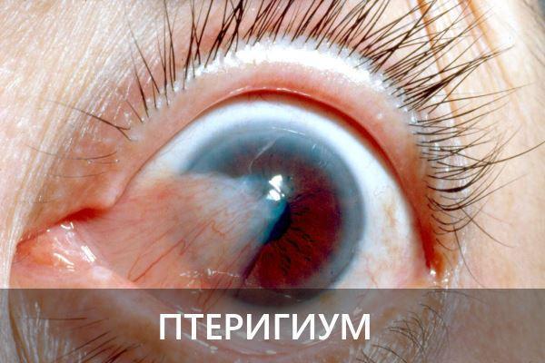 Плями на очному яблуці - причини, фото і що робити