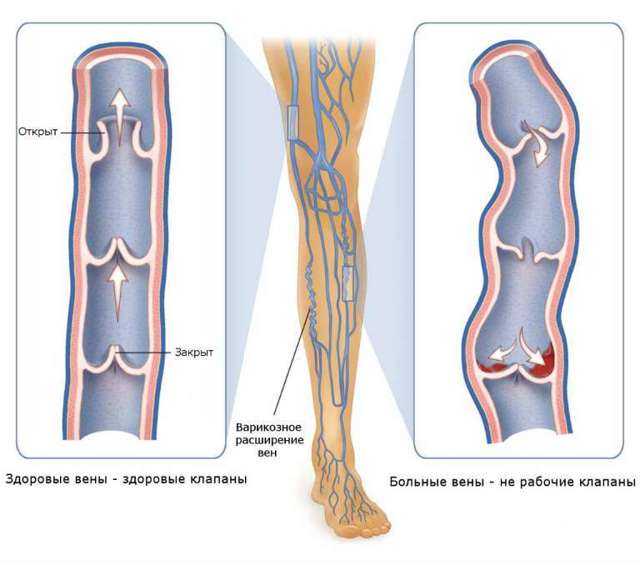Ретикулярний варикоз нижніх кінцівок: лікування, фото, ознаки, МКБ