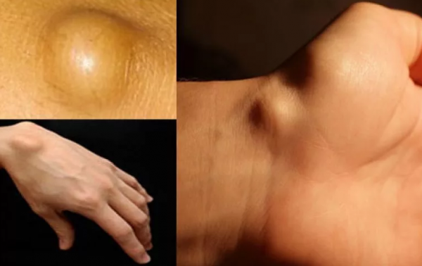 Твердий кулька або шишка під шкірою - причини, фото лікування