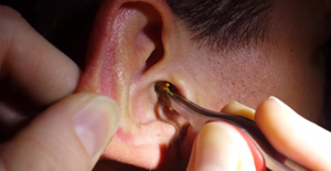 Чорні вугри в вухах - фото, причини, як позбутися