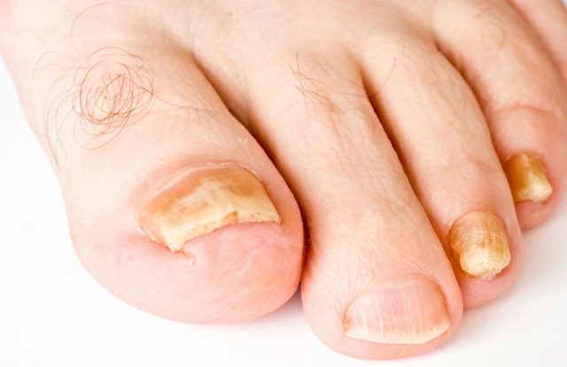 Погані, пошкоджені нігті - причини, фото, лікування