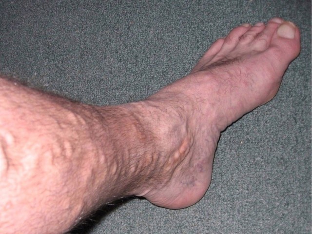 Сверблять ноги нижче колін - причини, фото, лікування