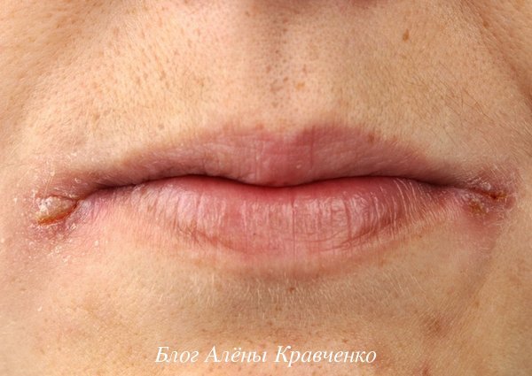 Червоні або білі болячки на губах - причини, фото, лікування