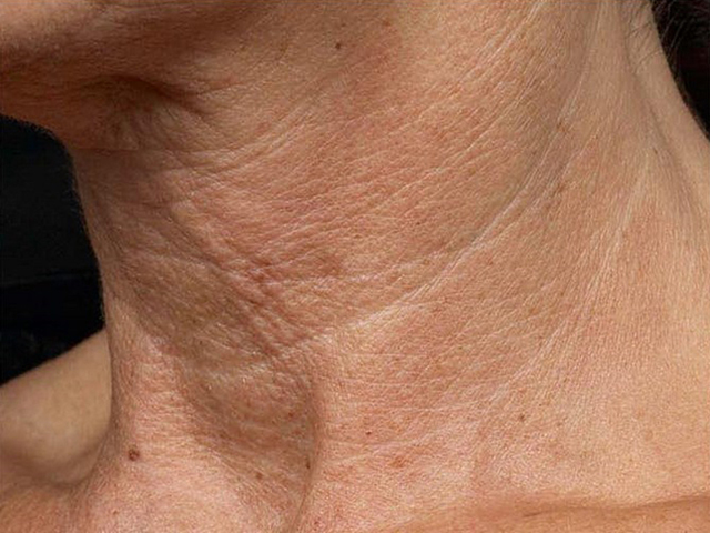 Зморшки на шиї - причини і як позбутися