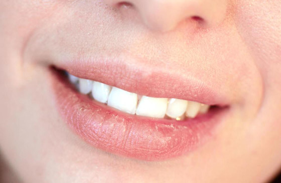 Набряк губ і його причини - алергія, травми, виразки і хвороби.  фото