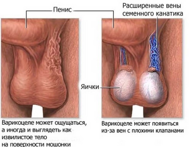 Варикоцеле зліва (1 і 2 ступеня): МКБ 10, причини, симптоми і лікування у чоловіків