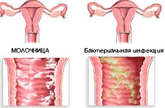 Колір вагінальних виділень у жінок - нормальний і тривожний