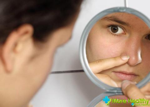 Почервоніння навколо носа - причини, фото і як позбутися?
