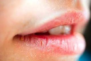 Грибок на губах у дорослого і дитини - причини, фото, лікування