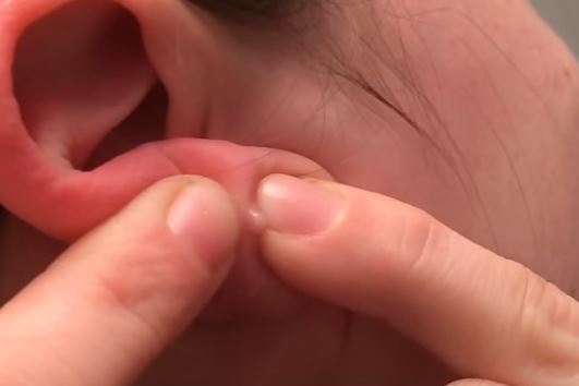 Опухла мочка вуха - причини, фото і що робити?