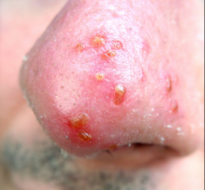 Інфекції носа і шкіри навколо - види, фото, симптоми, лікування