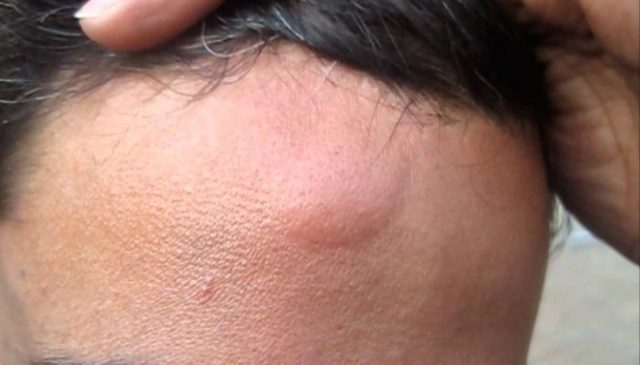 На лобі під шкірою з'явилася шишка (грудку) - причини, фото, лікування