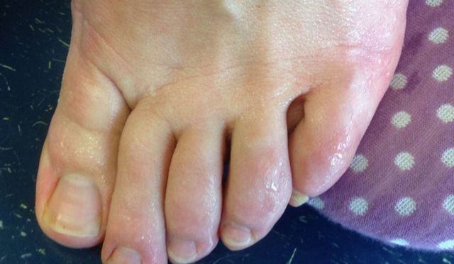 Злазить шкіра між пальцями ніг - причини, фото, лікування