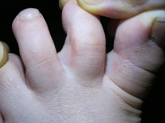 Злазить шкіра між пальцями ніг - причини, фото, лікування