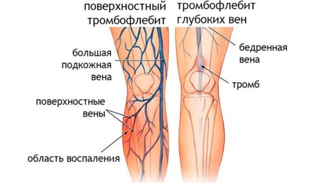 Варикозне розширення вен на ногах: причини, симптоми (як виглядає), лікування (медикаменти, хірургія, народні засоби), профілактика, ускладнення