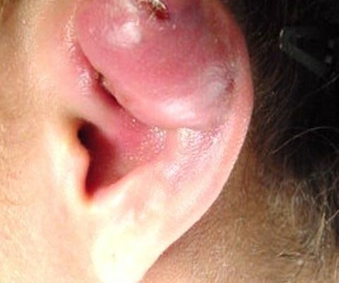 Опухла мочка вуха - причини, фото і що робити?