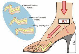 Натоптиші і мозолі на ногах - причини і лікування
