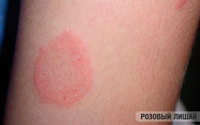 Червоні плями або крапки на ногах - причини, фото, лікування