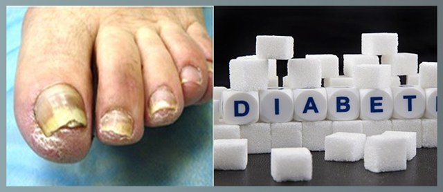 Нігті при діабеті цукровому на ногах: грибок, врослі, чорніють - лікування, фото