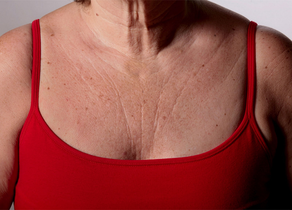 Зморшки на грудях - причини і як позбутися