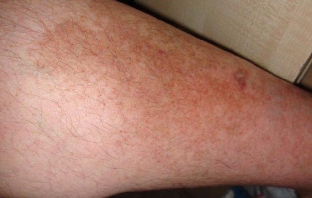 Червоні плями або крапки на ногах - причини, фото, лікування
