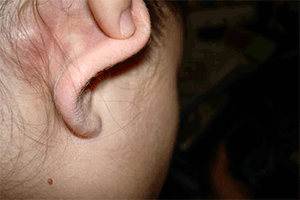 Кіста за вухом або на мочці - фото, причини, лікування
