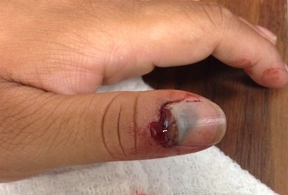 Погані, пошкоджені нігті - причини, фото, лікування