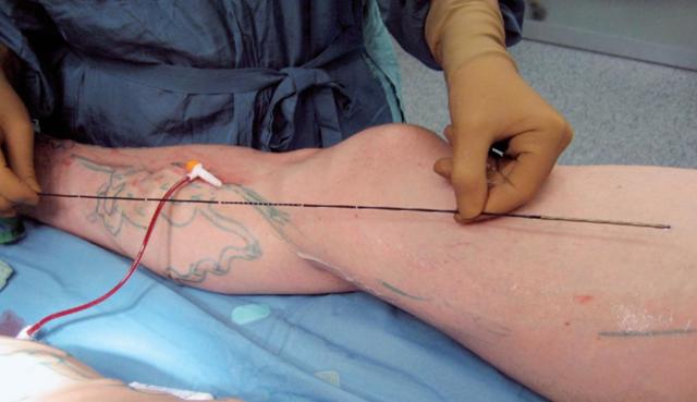 Болі при варикозі нижніх кінцівок (після операції, при вагітності): чим пояснити і як зняти