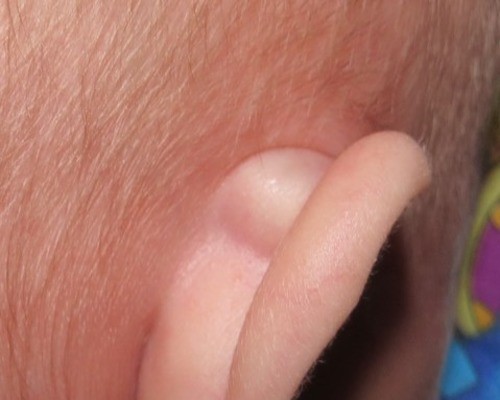 За вухом з'явилася шишка - причини, фото, лікування