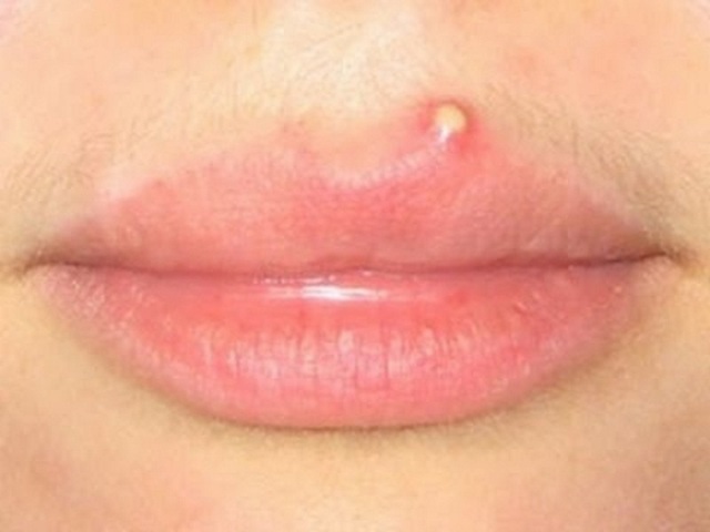 Угри на губах - причини, лікування в домашніх умовах
