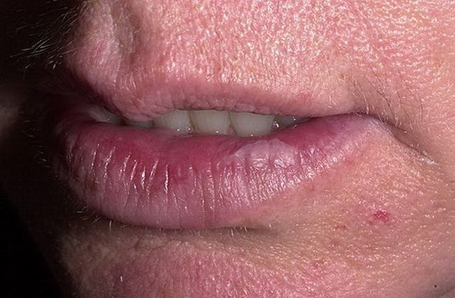 Екзема на губах - причини, симптоми, лікування