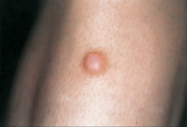 Твердий кулька або шишка під шкірою - причини, фото лікування