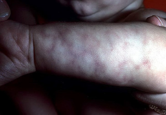 Мармурова шкіра - причини, види фото, лікування