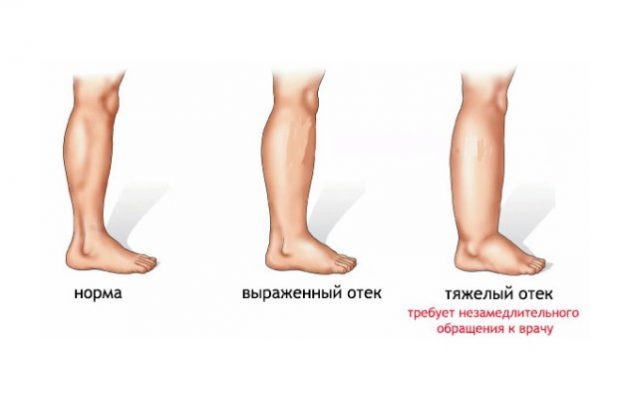 Варикозне розширення вен на ногах: причини, симптоми (як виглядає), лікування (медикаменти, хірургія, народні засоби), профілактика, ускладнення