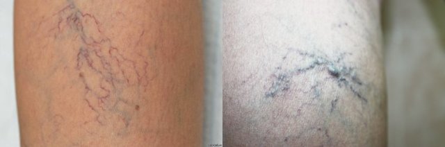 Початкова стадія варикозу на ногах: способи лікування і як розпізнати (симптоми, діагностика)