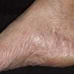 Лущиться, облазив шкіра ніг - причини, фото, лікування