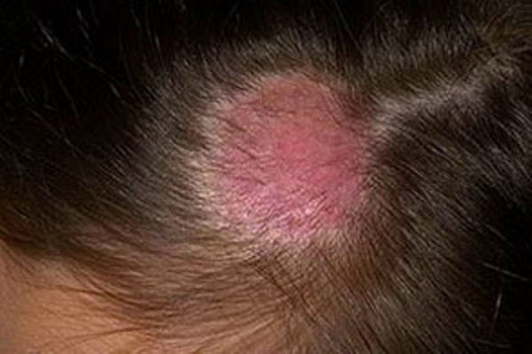 Нав'язливе розчісування шкіри голови - причини, симптоми лікування